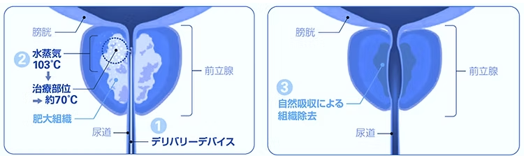 デリバリーデバイスを尿道に挿入し、前立腺にニードルを穿刺して加熱された水蒸気を放出します。加熱された前立腺組織は壊死して退縮します。