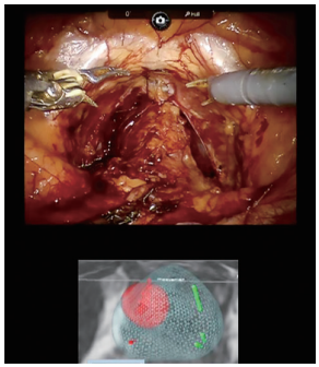 (図4)手術時に術者が見ている画面。上段はダビンチによる前立腺全摘除術の術野。下段は癌病巣（赤丸で表示）を示した３D画像。