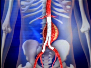 腹部大動脈瘤